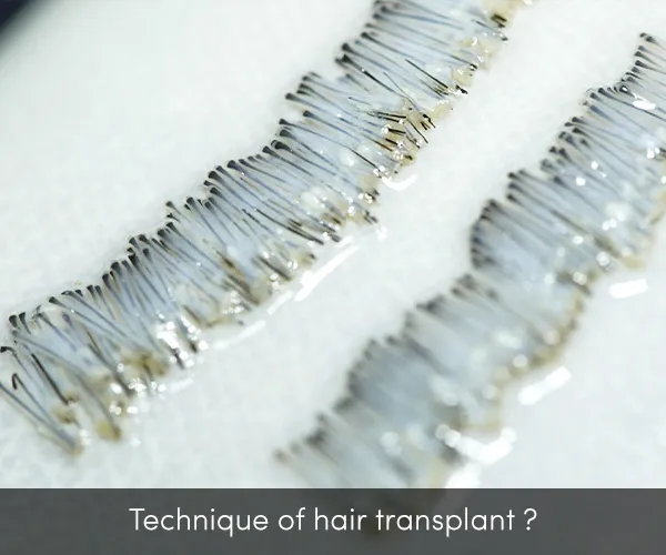 hair transplant clinic in indore, hair transplant centre in indore