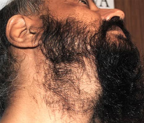 beard hair transplant doctor in indore, beard hair transplant clinic in indore
