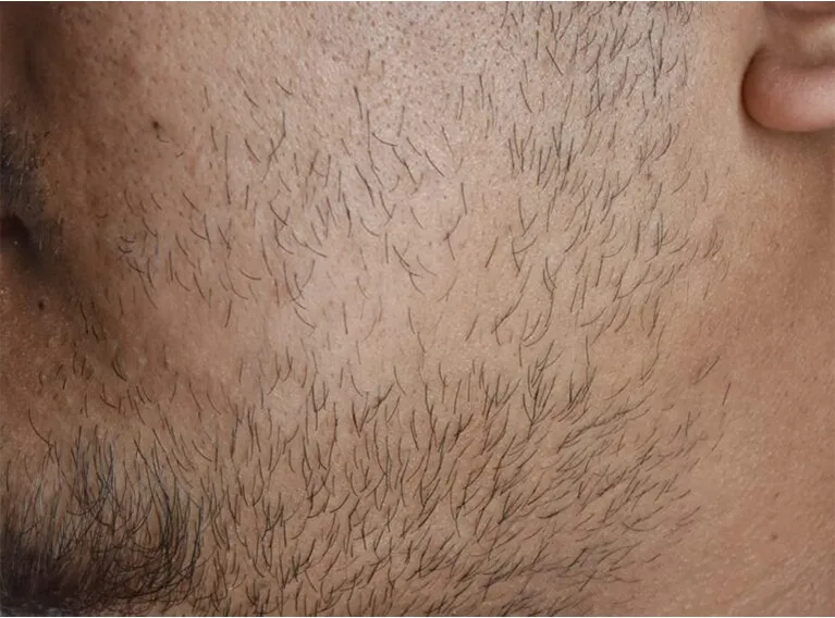 beard hair transplant specialist in indore, beard hair transplant procedure in indore