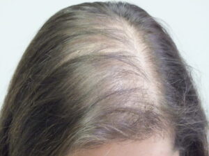 prp hair transplant in indore