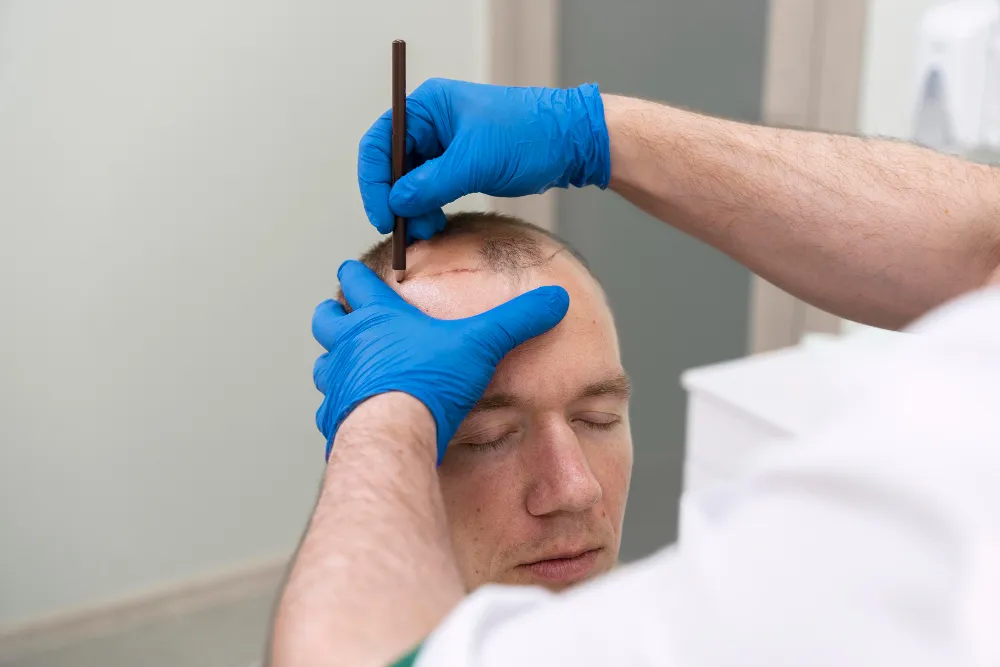 hair transplant doctor in Indore, hair doctor in indore